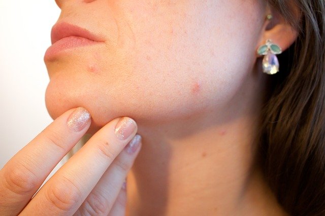 Acne Treatment Facial